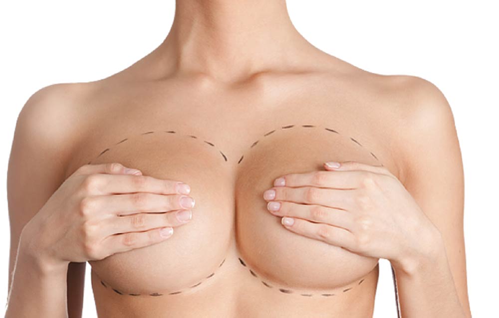 operatie-de-augmentare-mamara